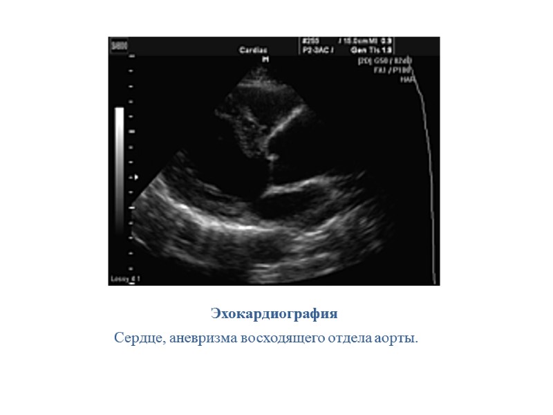 Эхокардиография Сердце, аневризма восходящего отдела аорты.